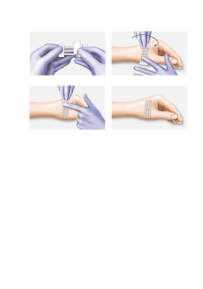 Hartmann Omnistrip® wondhechtstrip